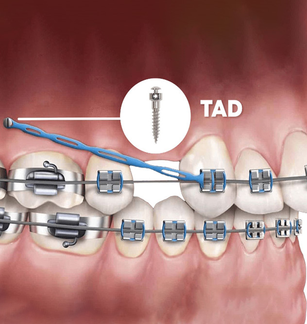 How do TADs assist
orthodontic treatment? How do TADs assist
orthodontic treatment?