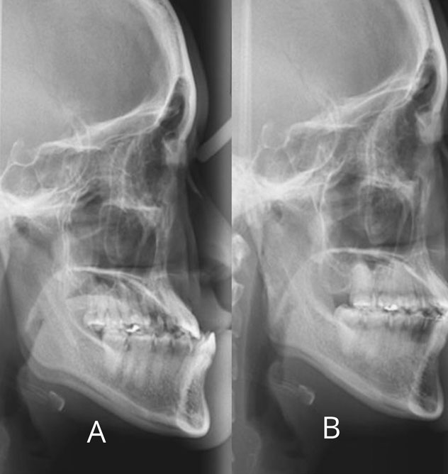 Jaw surgery
with Invisalign® Jaw surgery
with Invisalign®