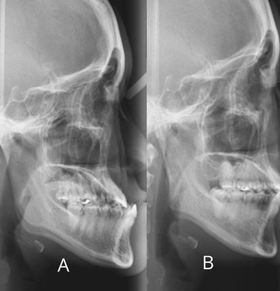 Jaw surgery
with braces Jaw surgery
with braces