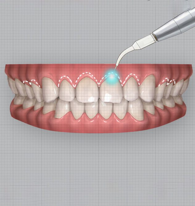 How does gingival recontouring work? How does gingival recontouring work?